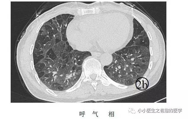 肺栓塞提高篇：CT平扫可发现、甚至诊断肺栓塞，看看国外高手论肺栓塞