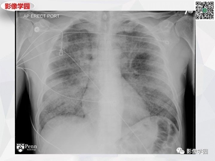【双语病例】肺泡蛋白沉积症PAP一例CT