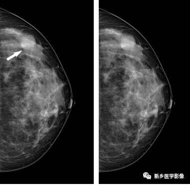 乳腺9大基本病变，必须掌握的基础
