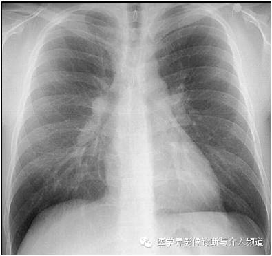 肺结节病1例X线影像表现