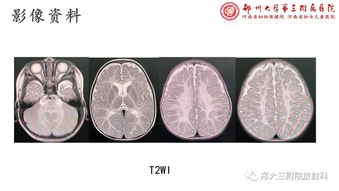 【PPT】佩梅病的影像诊断-5