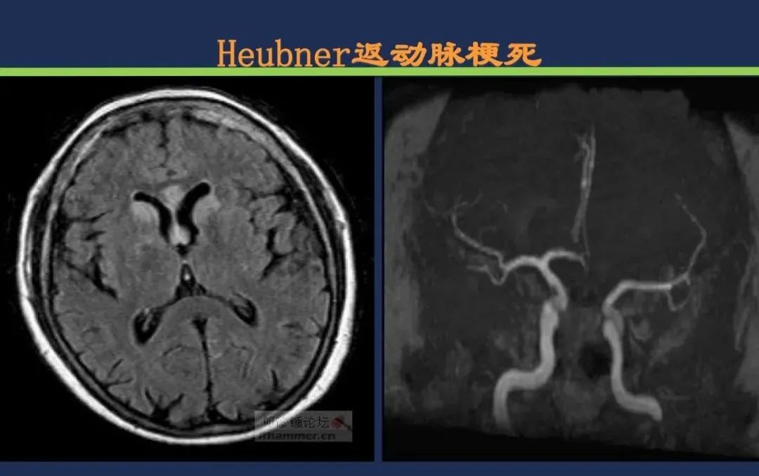 从梗死部位推测责任血管：脑血管解剖-68