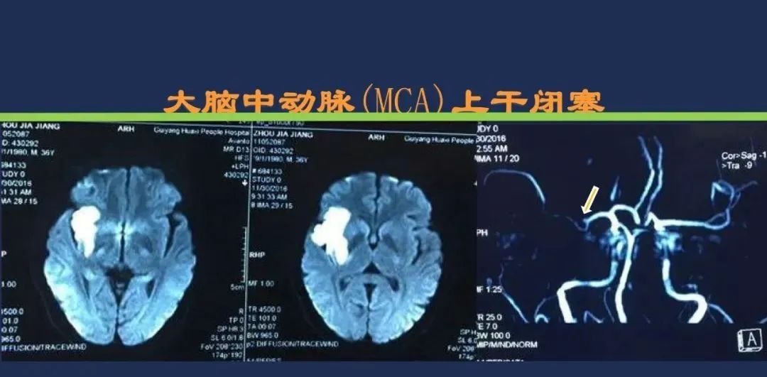 从梗死部位推测责任血管：脑血管解剖-45