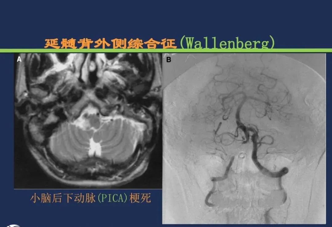 从梗死部位推测责任血管：脑血管解剖-166