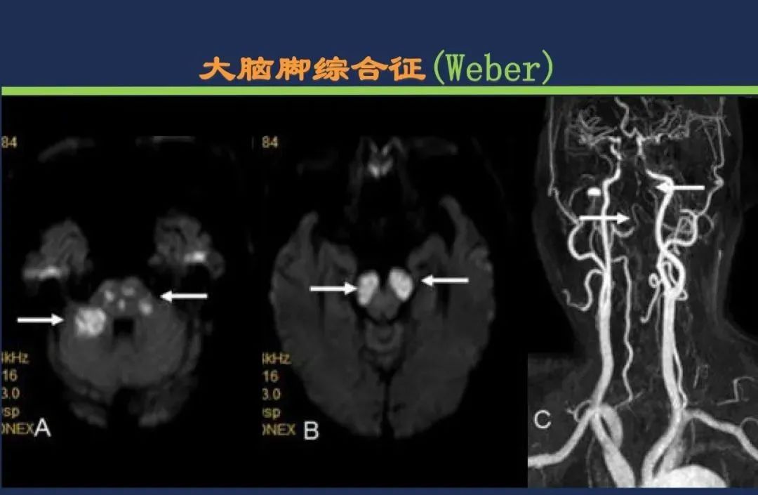 从梗死部位推测责任血管：脑血管解剖-153