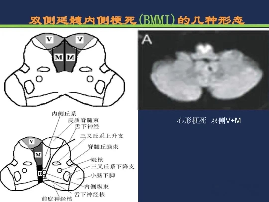 从梗死部位推测责任血管：脑血管解剖-201
