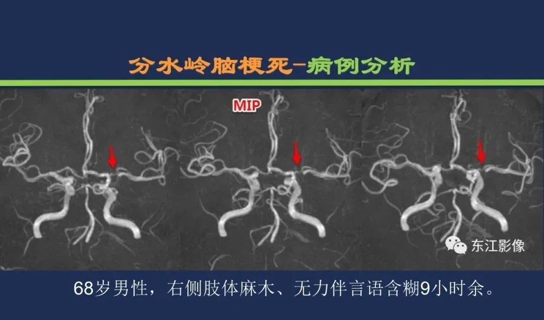 从梗死部位推测责任血管：脑血管解剖-248