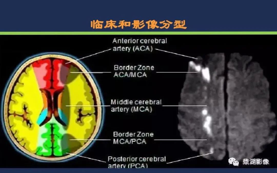 从梗死部位推测责任血管：脑血管解剖-231