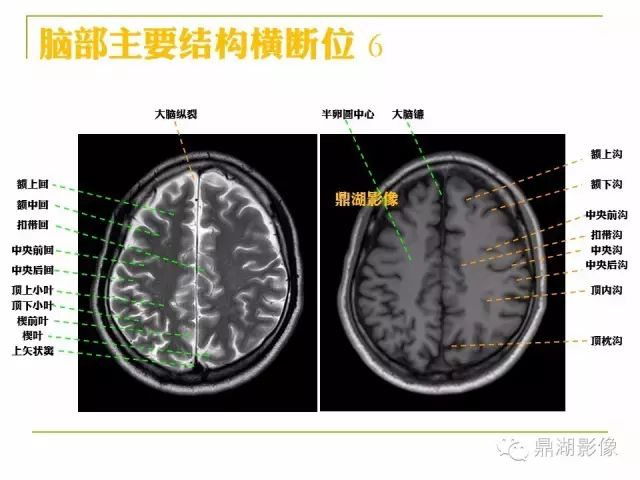 颅脑大体及磁共振断层解剖
