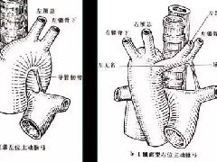 先天性心脏病的影像学改变