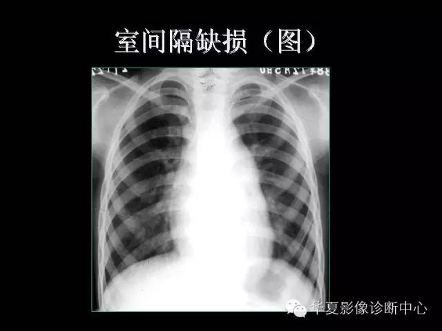 【PPT】先天性心脏病的影像学改变