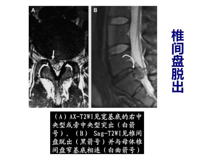 【PPT】腰椎退行性疾病影像学诊断