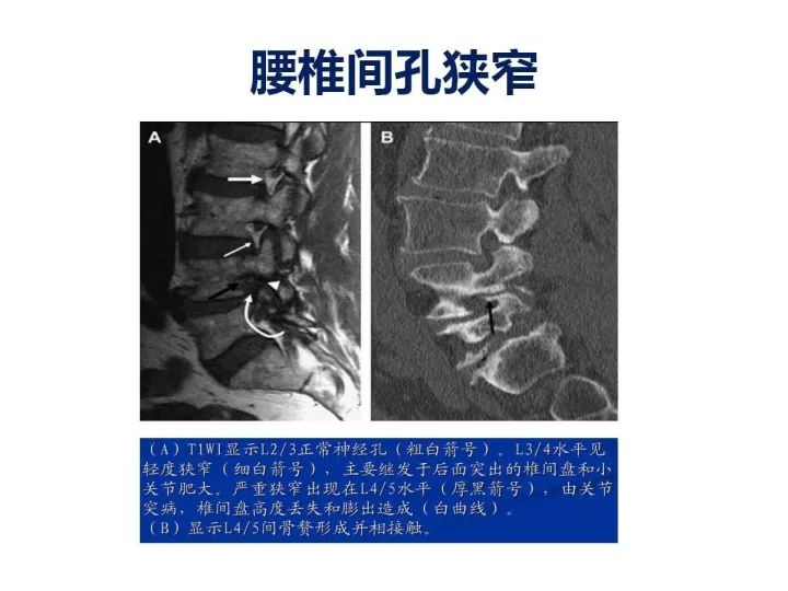 【PPT】腰椎退行性疾病影像学诊断
