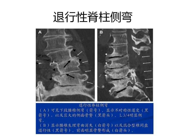 【PPT】腰椎退行性疾病影像学诊断