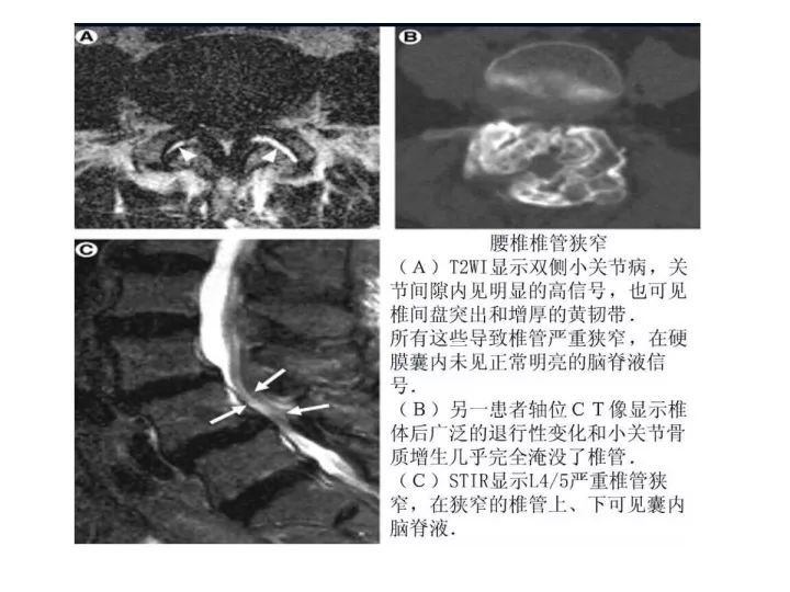 【PPT】腰椎退行性疾病影像学诊断