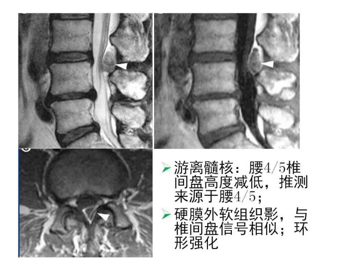 【PPT】腰椎退行性疾病影像学诊断