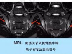 <b>骶髂关节非肿瘤病变的影像诊断</b>