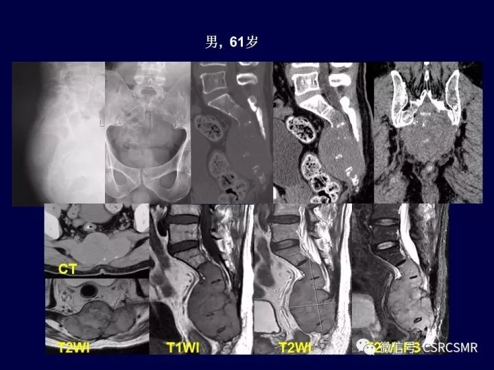 【PPT】骶骨病变的影像诊断与鉴别诊断