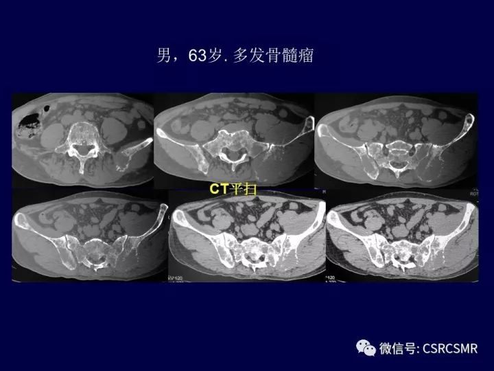 【PPT】骶骨病变的影像诊断与鉴别诊断