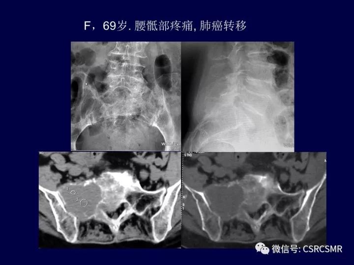 【PPT】骶骨病变的影像诊断与鉴别诊断
