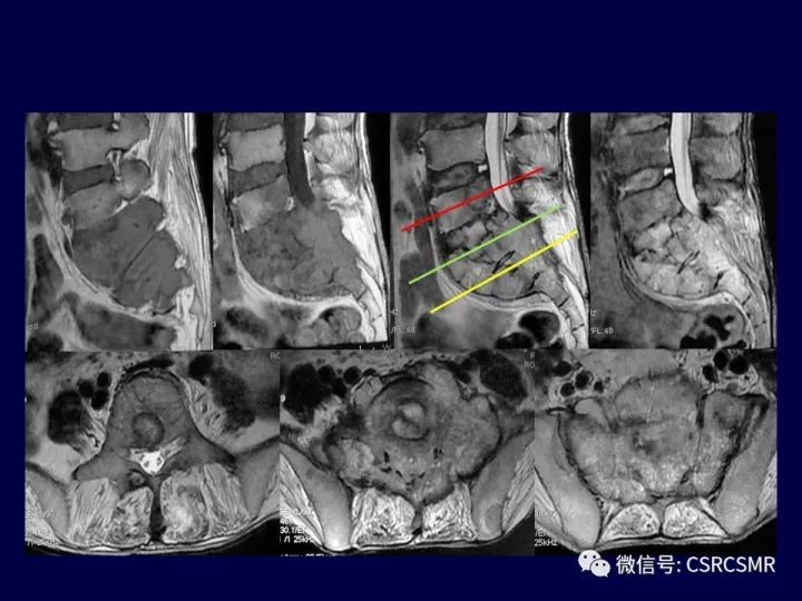 【PPT】骶骨病变的影像诊断与鉴别诊断
