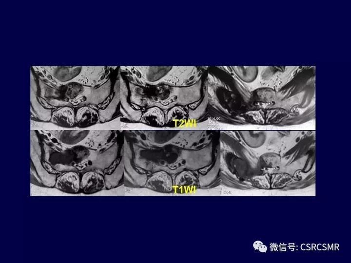 【PPT】骶骨病变的影像诊断与鉴别诊断