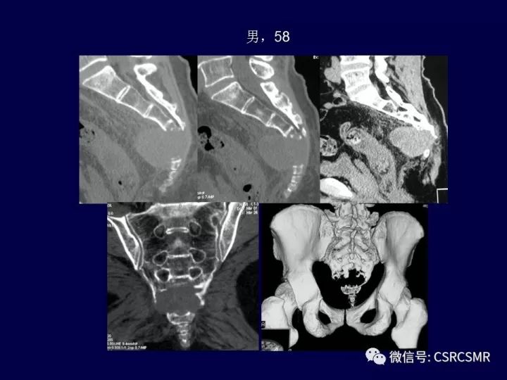 【PPT】骶骨病变的影像诊断与鉴别诊断