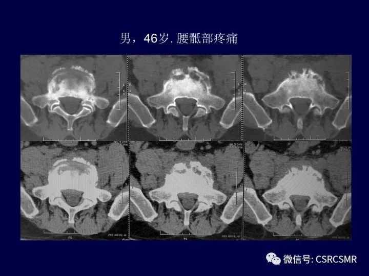 【PPT】骶骨病变的影像诊断与鉴别诊断