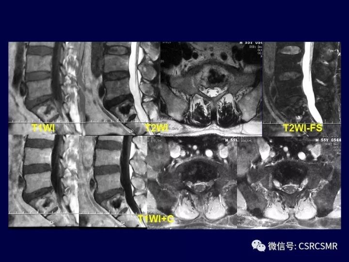 【PPT】骶骨病变的影像诊断与鉴别诊断