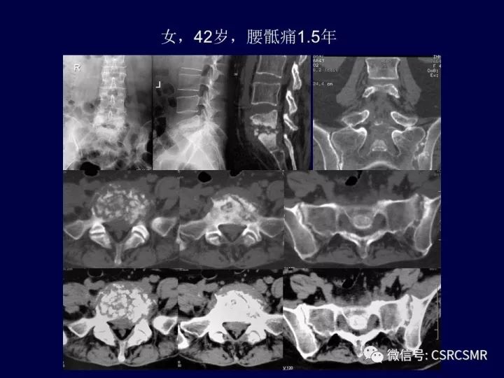 【PPT】骶骨病变的影像诊断与鉴别诊断