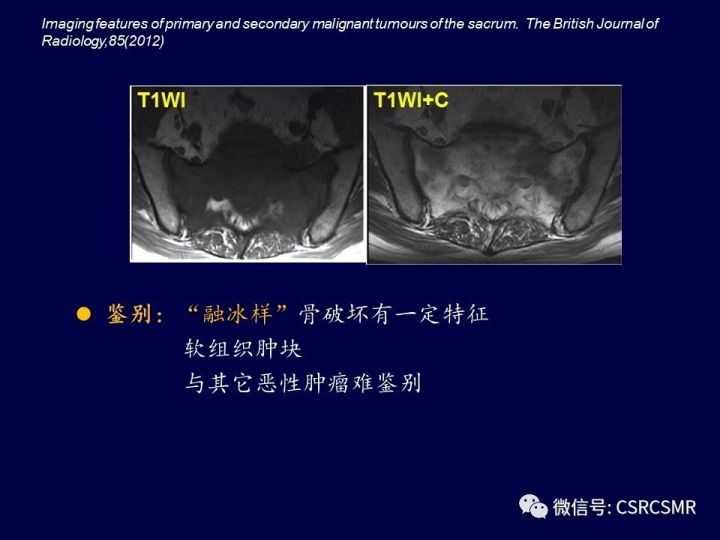 【PPT】骶骨病变的影像诊断与鉴别诊断