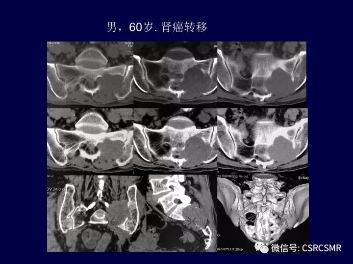【PPT】骶骨病变的影像诊断与鉴别诊断