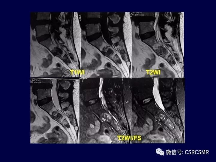 【PPT】骶骨病变的影像诊断与鉴别诊断