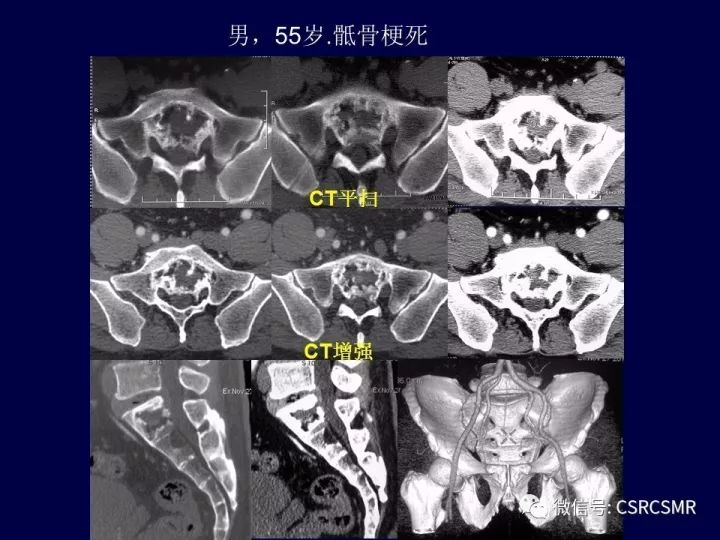【PPT】骶骨病变的影像诊断与鉴别诊断