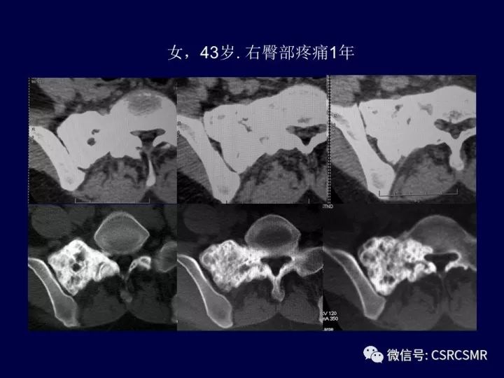 【PPT】骶骨病变的影像诊断与鉴别诊断
