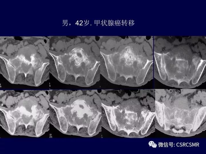 【PPT】骶骨病变的影像诊断与鉴别诊断
