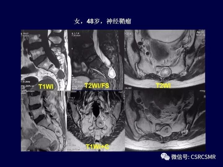 【PPT】骶骨病变的影像诊断与鉴别诊断