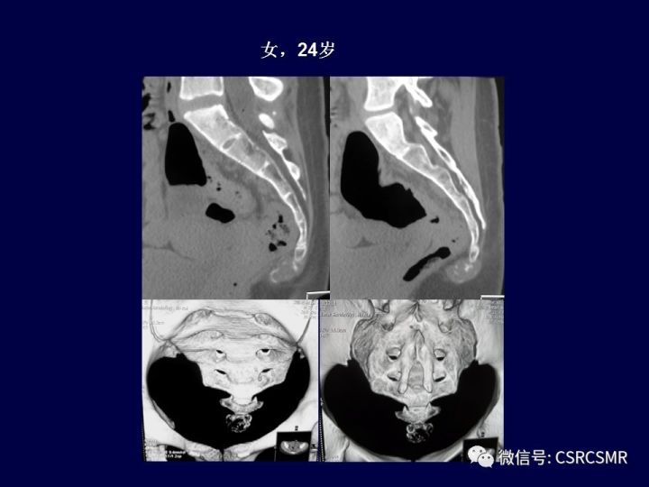 【PPT】骶骨病变的影像诊断与鉴别诊断
