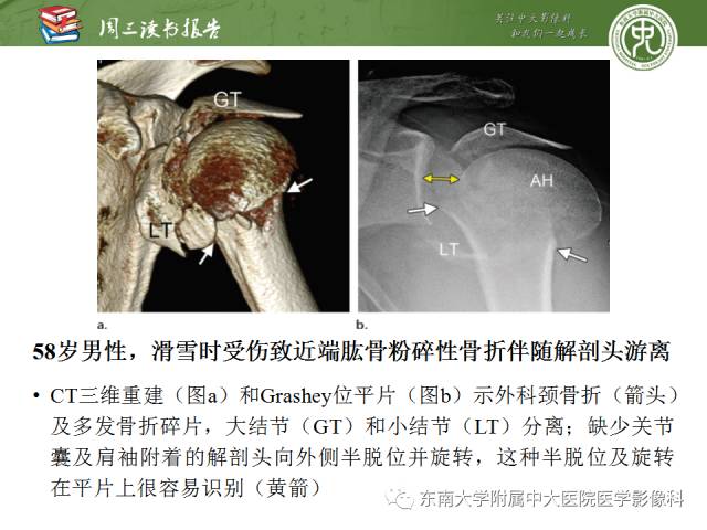 【PPT】急性肩关节损伤：外科医生想获知的内容