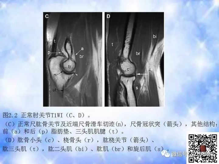 【PPT】肘关节磁共振正常解剖及假性病变