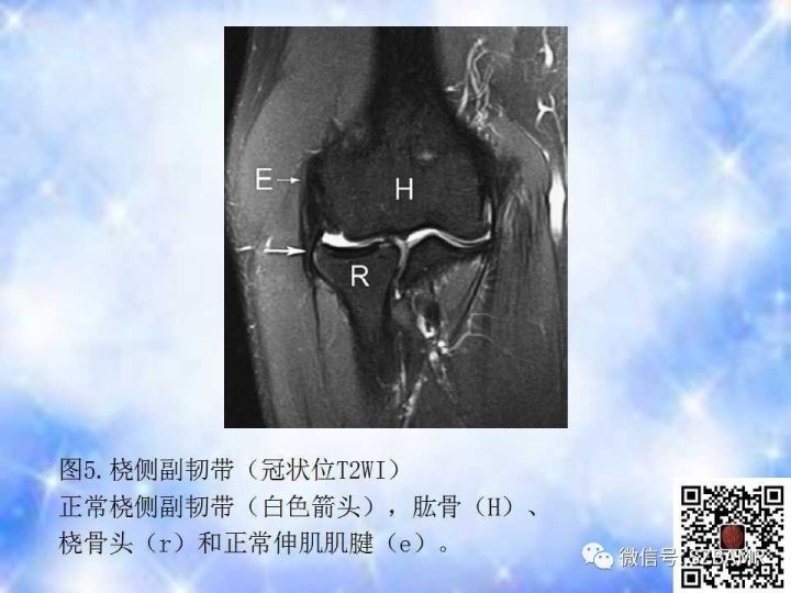 【PPT】肘关节磁共振正常解剖及假性病变