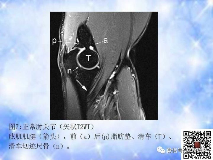 【PPT】肘关节磁共振正常解剖及假性病变