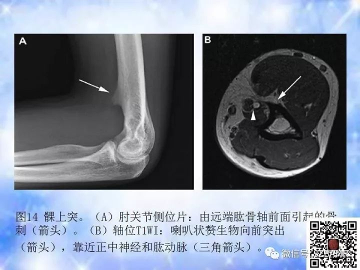 【PPT】肘关节磁共振正常解剖及假性病变