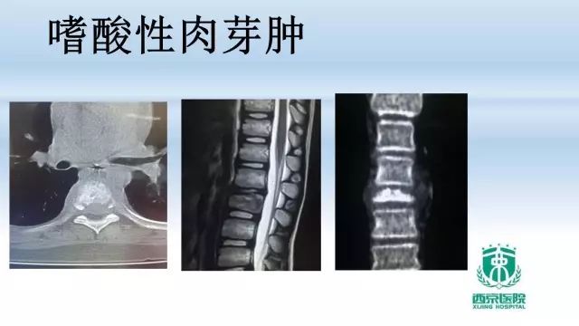 常见椎体单发溶骨性病变