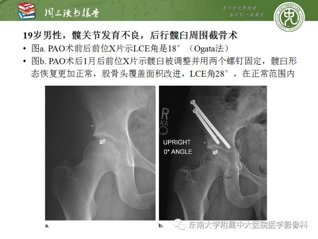 【PPT】髋关节保留术术后影像学表现