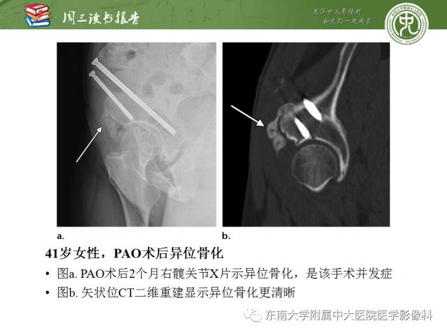 【PPT】髋关节保留术术后影像学表现