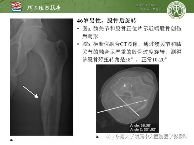 【PPT】髋关节保留术术后影像学表现