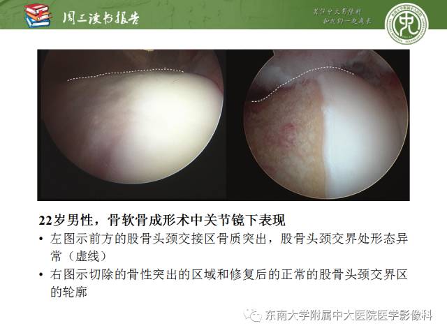 【PPT】髋关节保留术术后影像学表现