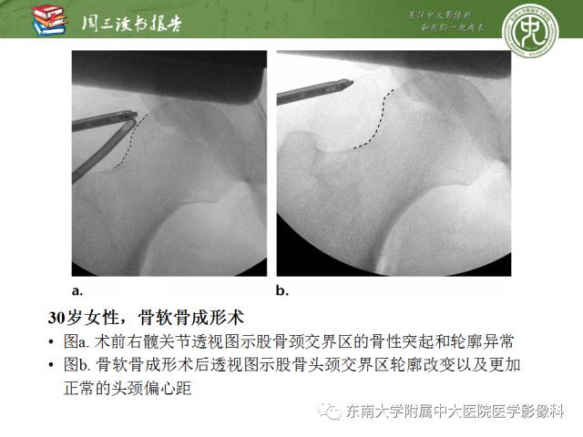 【PPT】髋关节保留术术后影像学表现