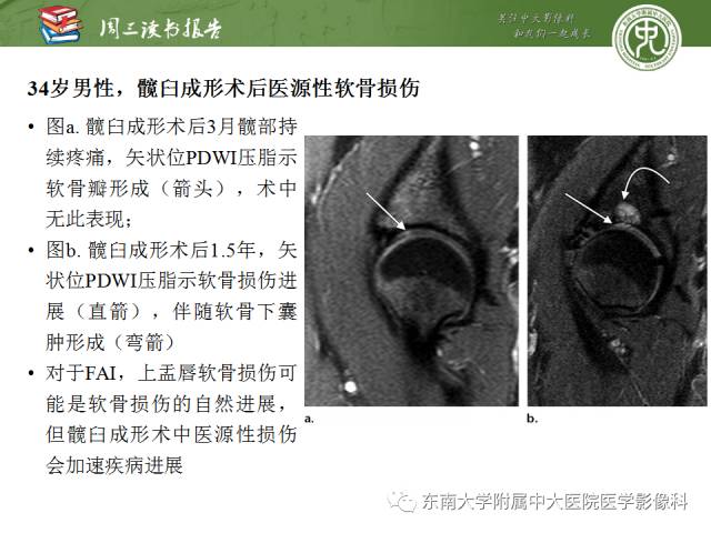 【PPT】髋关节保留术术后影像学表现